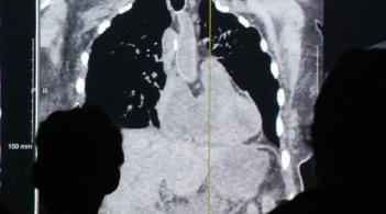 silhouette of people viewing a thorax xray