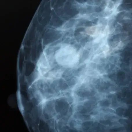 Mammogram of breast tissue