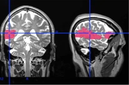 Magnetic resonance image of a patient’s brain after stroke.