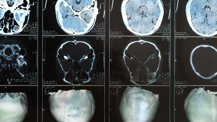 brain scans on a computer screen