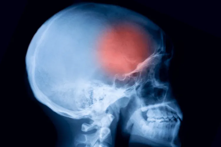 An x-ray image of a skull with a red circle denoting the front of the brain.
