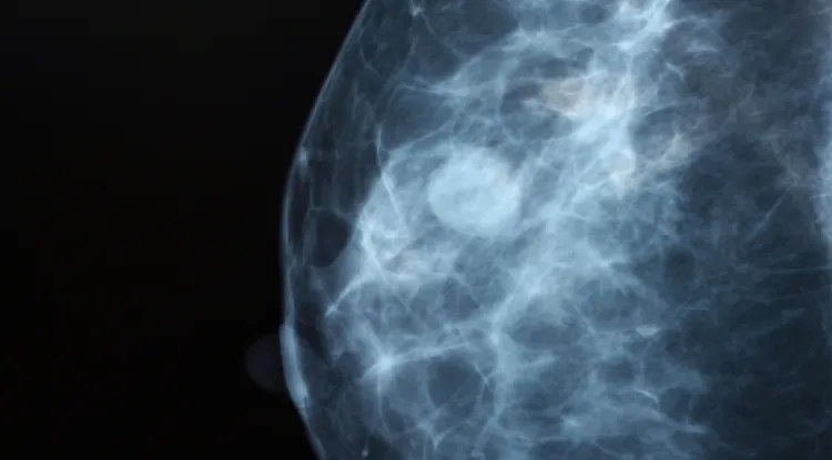 a breast mammogram image