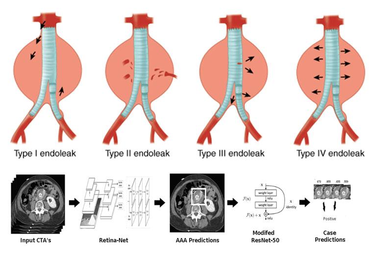 Automated binary classification of Endoleaks graphics