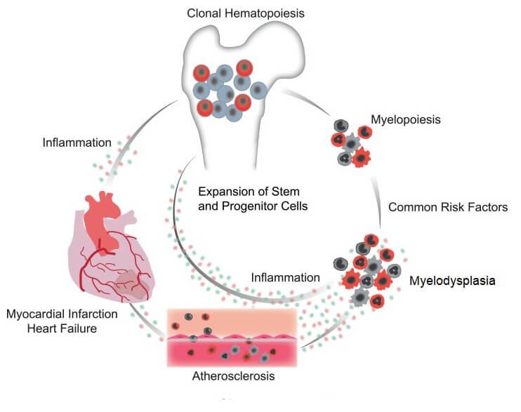 Image showing how patients with myelodysplastic Syndromes (blood cancers) are at high risk for cardiovascular disease.