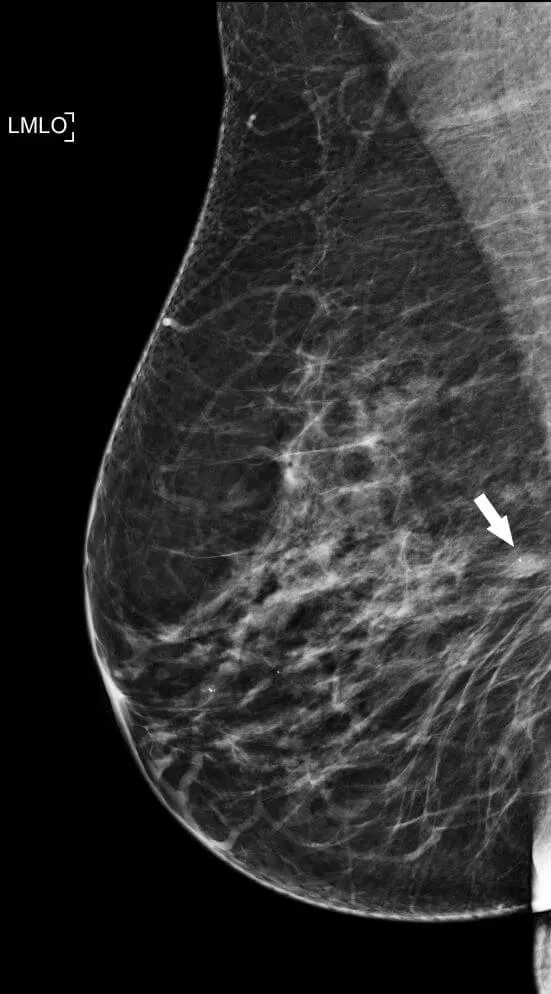 Left breast mammographic MLO view