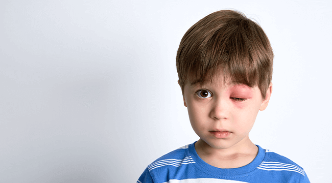a child with a red, swollen eye