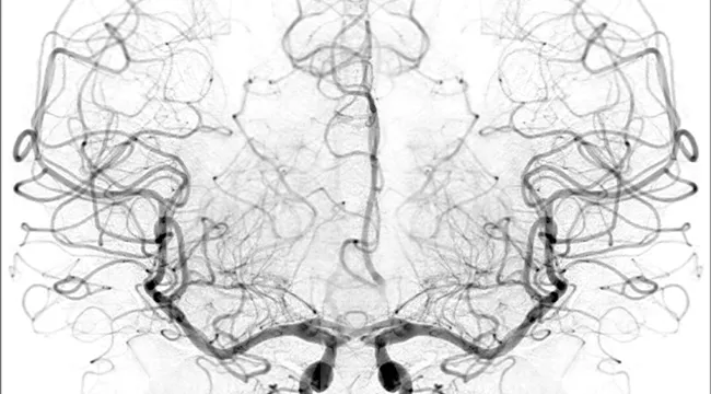 image showing blood flow in the brain