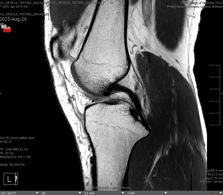 lateral mri knee