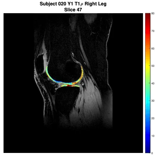 processed knee MRI