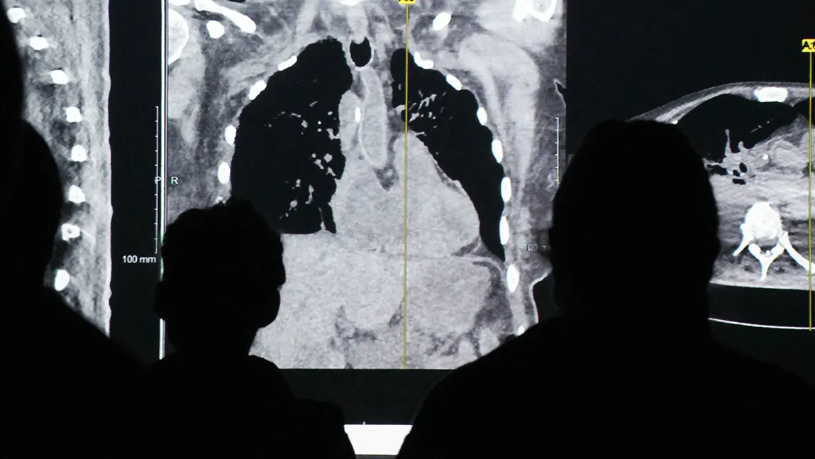 People standing in front of lung medical images
