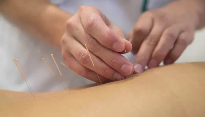 Acupuncture treatment