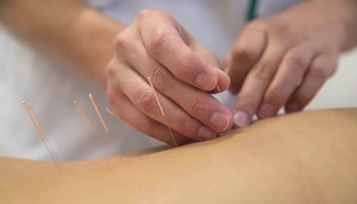 Acupuncture treatment