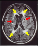 Brain MRI of a patient with SVD showing lacunar infarcts (red arrows) and white matter lesions (yellow arrows).